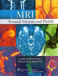 MRI Normal Variants and Pitfalls