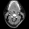 MRIOnline Imaging Mastery Series: Pathology of the Oral Cavity and Oropharynx 2020 (CME VIDEOS)