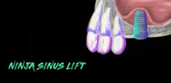 Ninja Sinus Lift
