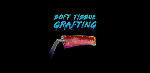 Ninja Soft Tissue Grafting