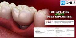 OHI-S Implantation Without Peri-Implantitis (Course)