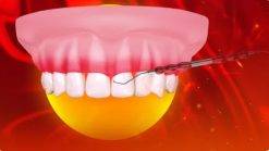 Ohi-Non-surgical periodontal therapy and minimally invasive protocols