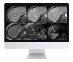 Liver, Pancreatic, and Biliary Tumors