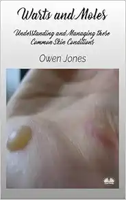 Warts And Moles: Understanding And Managing These Common Skin Conditions (EPUB)